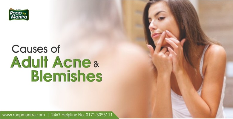 Causes Of Adult Acne And Blemishes Roop Mantra Blog Skin Care Tips For Healthy Glowing Skin