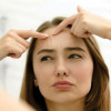 How-to-get-rid-of-Forehead-Acne-Find-your-answer-here
