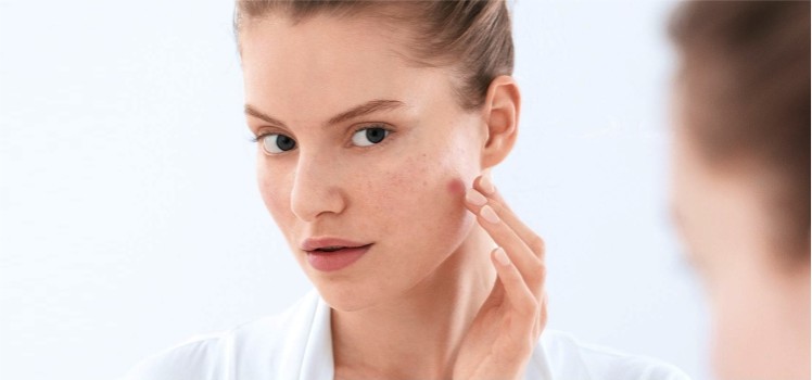 How-to-Reduce-Pimple-Redness-with-the-Help-of-Home-Remedies-blog